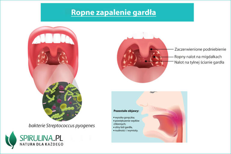 Ropne zapalenie gardła algi Spirulina i Chlorella