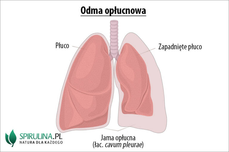 Odma opłucnowa algi Spirulina i Chlorella