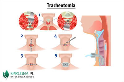 Tracheotomia Algi Spirulina I Chlorella