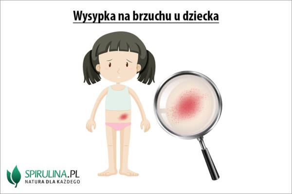 Wysypka Na Brzuchu U Dziecka Algi Spirulina I Chlorella