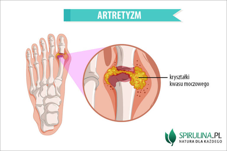 Artretyzm Algi Spirulina I Chlorella