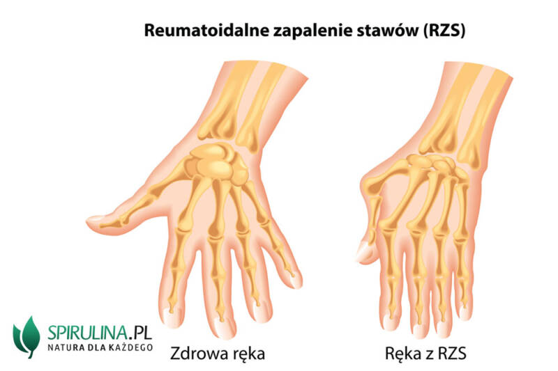 Reumatoidalne Zapalenie Stawów Algi Spirulina I Chlorella 2229