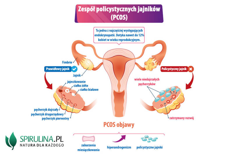 Zespół Policystycznych Jajników Algi Spirulina I Chlorella 5739