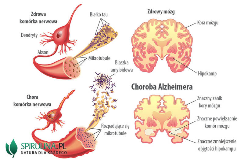 Choroba Alzheimera Algi Spirulina I Chlorella 4177