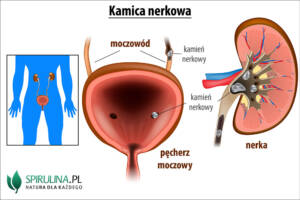 Kolka nerkowa (kamica nerkowa)