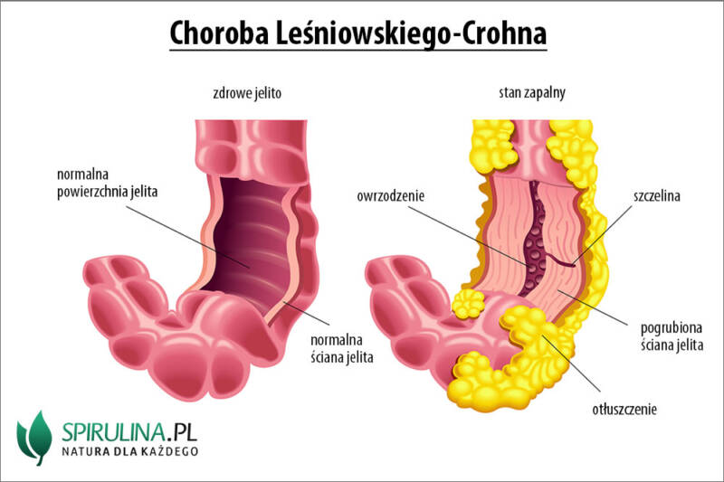 Choroba Leśniowskiego Crohna Algi Spirulina I Chlorella 4092