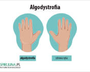 Algodystrofia