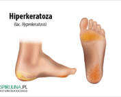 Hiperkeratoza