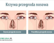 Krzywa przegroda nosowa