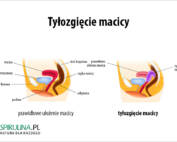 Tyłozgięcie macicy