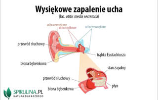 Wysiękowe zapalanie ucha