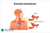 Krwotok wewnętrzny