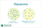 Oligospermia