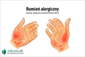 Rumień alergiczny