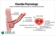 Choroba Peyroniego