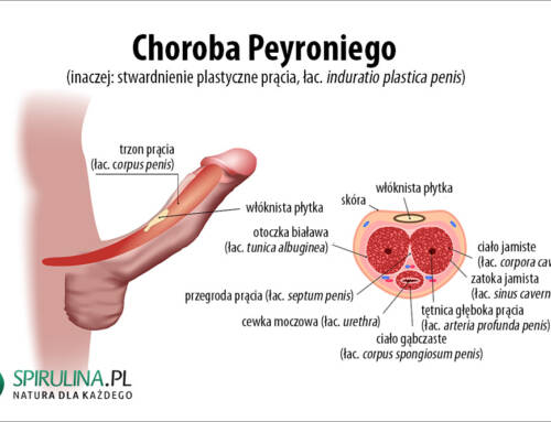 Choroba Peyroniego