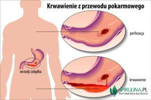 Krwawienie z przewodu pokarmowego