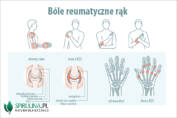 Bóle reumatyczne rąk