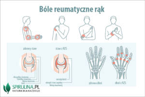 Bóle reumatyczne rąk