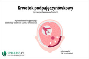 Krwotok podpajęczynówkowy