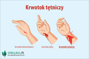 Krwotok tętniczy