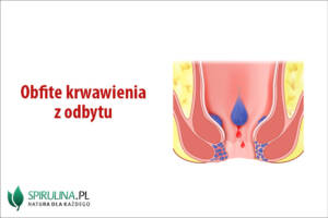 Obfite krwawienia z odbytu