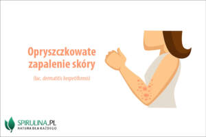 Opryszczkowate zapalenie skóry