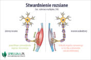 Stwardnienie rozsiane