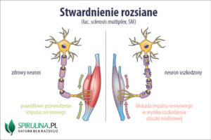 Stwardnienie rozsiane