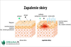 Zapalenie skóry