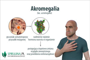 Akromegalia