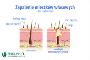 Zapalenie mieszków włosowych 