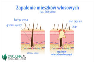 Zapalenie mieszków włosowych