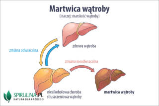 Martwica wątroby