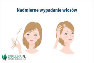 Nadmierne wypadanie włosów