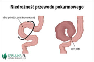 Niedrożność przewodu pokarmowego