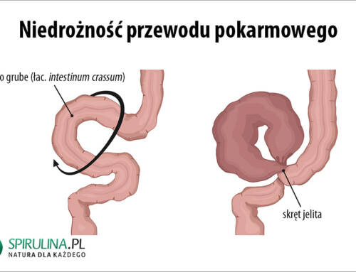 Niedrożność przewodu pokarmowego