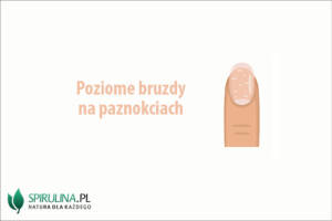 Poziome bruzdy na paznokciach