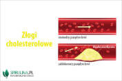 Złogi cholesterolowe