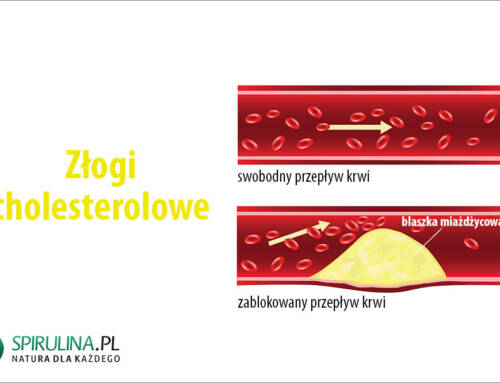 Złogi cholesterolowe