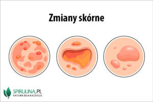 Zmiany skórne