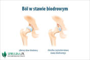 Ból w stawie biodrowym