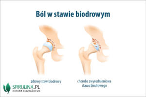 Ból w stawie biodrowym