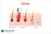 Epilacja