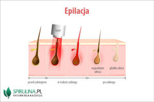 Epilacja