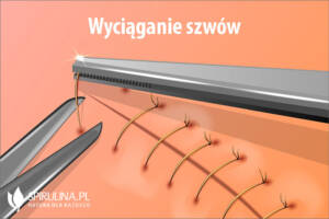 Wyciąganie szwów