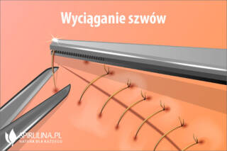 Wyciąganie szwów