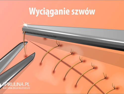 Wyciąganie szwów