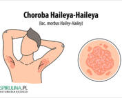 Choroba Haileya-Haileya