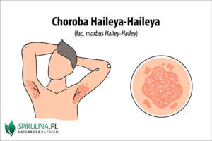 Choroba Haileya-Haileya